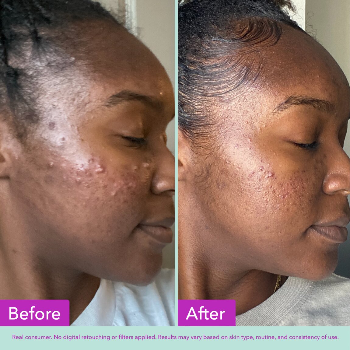 acne-foaming-cleanser-l1 zb_p.jpg